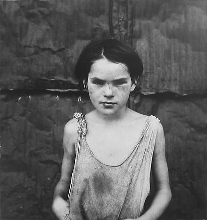 Damaged Child, Shacktown, Elm Grove, Oklahoma, 1936